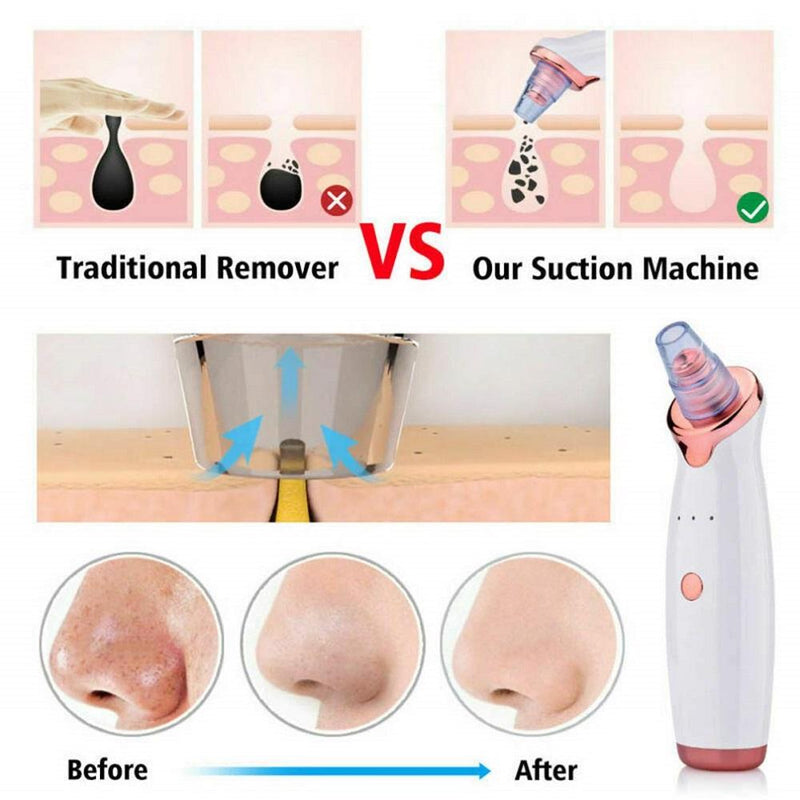 Blackhead Remover Cleaner Tool Electric Pore Acne Pimple Removal SP